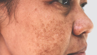 Hyperpigmentation Skin